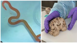Un vierme uriaș, găsit &icirc;n creierul unei femei. "Este viu. Vom vedea tot mai multe cazuri de acest fel"