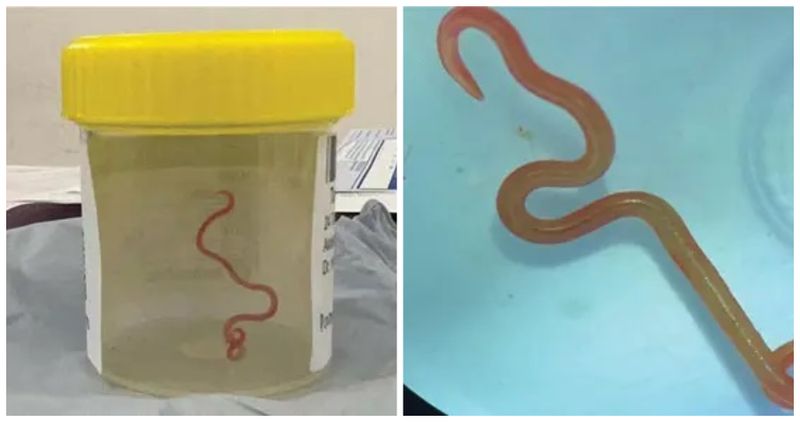 Un vierme uriaș, găsit în creierul unei femei. "Este viu"