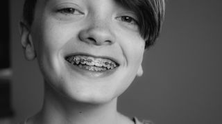 Cum să alegi cel mai potrivit aparat dentar pentru tine: ghidul complet al pacientului