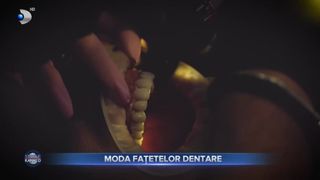 VIDEO - Moda fațetelor dentare este în continuă dezvoltare. Tot mai mulți români apelează la această procedură pentru a avea un zâmbet strălucitor