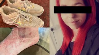 A luat scabie după ce a purtat o pereche de adidași, second-hand. Declarația halucinantă a femeii: "Voi continua să cumpăr"