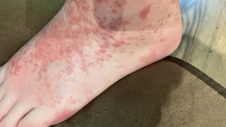 A luat scabie după ce a purtat o pereche de adidași, second-hand.