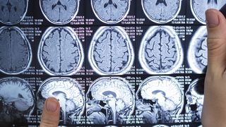 Experimentele pe creierul uman au fost aprobate. 