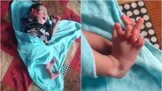 Fetița care s-a născut cu 26 de degete este văzută ca fiind reîncarnarea unei zeițe hinduse. Ea a fost diagnosticată cu polidactilie: „Suntem foarte fericiți!”