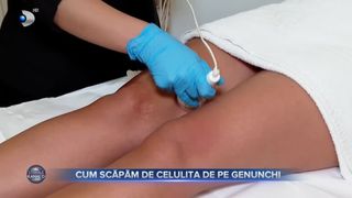 VIDEO - Cum scăpăm de celulita de pe genunchi? „Procedura care dă rezultate de la prima ședință este radiofrecvența”