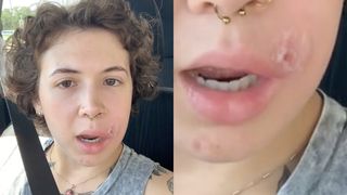 VIDEO. Drama prin care a trecut această tânără după ce a spart un banal coș. A suferit o infecție oribilă. „A fost mai rău decât nașterea”