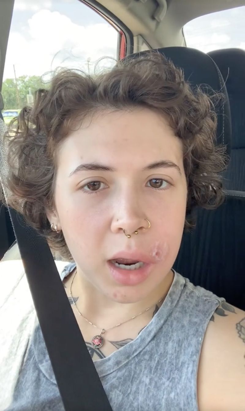 VIDEO. Drama prin care a trecut această tânără după ce a spart un banal coș. A suferit o infecție oribilă. „A fost mai rău decât nașterea”