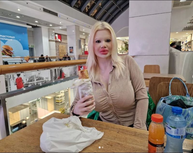 Femeia cu cele mai mari buze din lume vrea acum cei mai mari obraji: „Voi continua cu mai multe injecții”