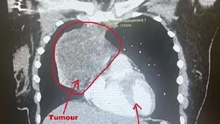 Tumora de 12 cm a lui Zoe Plastiras