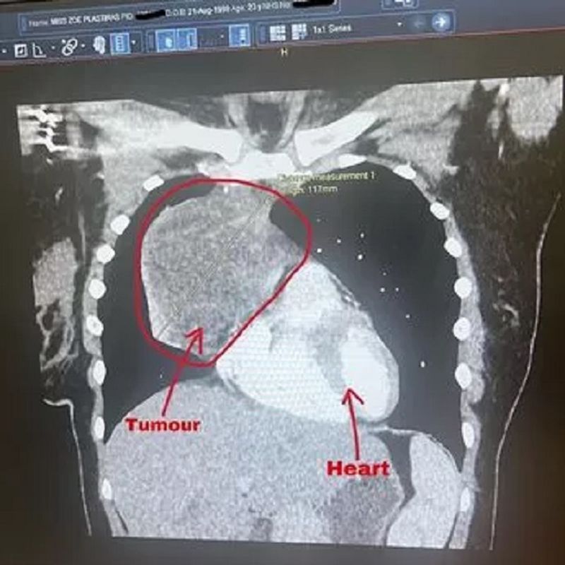 Tumora de 12 cm a lui Zoe Plastiras