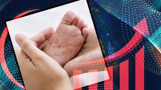 Numărul cazurilor de rujeolă, din ce în ce mai mare. ,,Creşterea cazurilor de rujeolă este cel mai clar semn al unei întreruperi în acoperirea vaccinală''