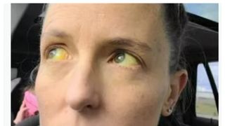 Pastile menopauză ochi galbeni