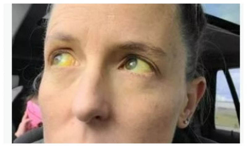 Pastile menopauză ochi galbeni