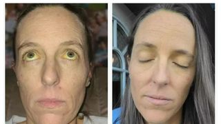 Pastile menopauză ochi galbeni