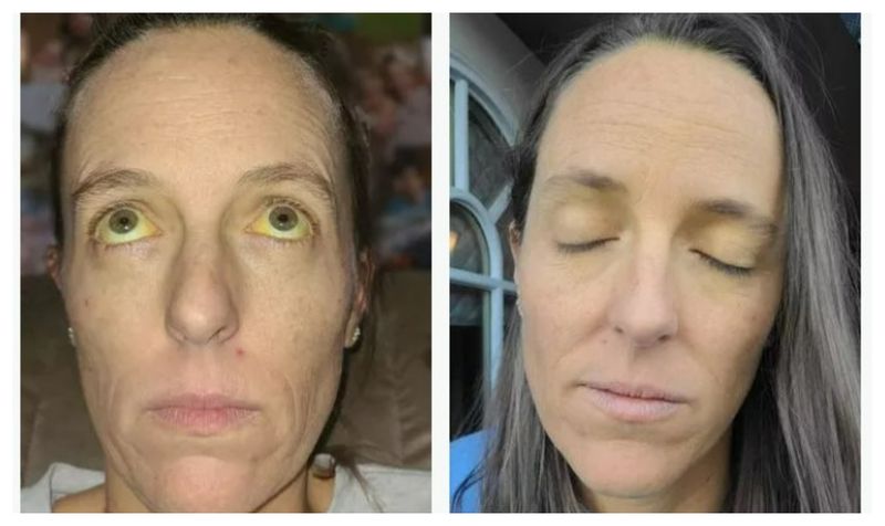 Pastile menopauză ochi galbeni