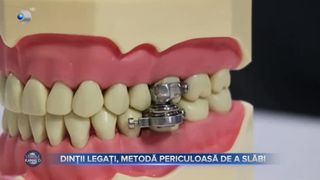 VIDEO - Dinții legați, metodă periculoasă de slăbit. La ce riscuri se supun persoanele care apelează la această metodă?