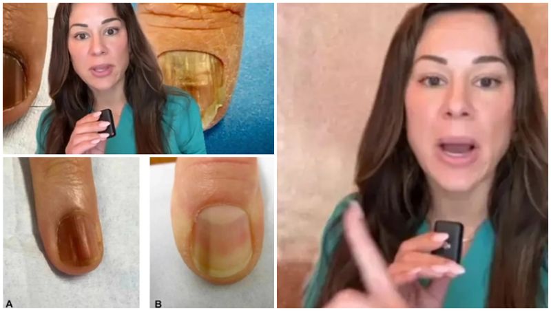 Semnul de pe unghie care îți poate indica o boală gravă