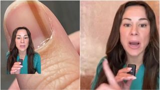 Semnul de pe unghie care &icirc;ți poate indica o boală gravă. "Nu ignorați asta niciodată!", spune un medic dermatolog