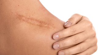 Ce trebuie să faci pentru a-ți vindeca rănile, fără să răm&acirc;nă semne?