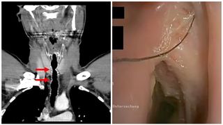 Cum i-a apărut părul &icirc;n g&acirc;t fumătorului din Austria