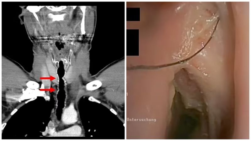 Cum i-a apărut părul în gât fumătorului din Austria