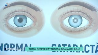 VIDEO Totul despre cataractă, boala ochiului! Cum se poate trata această afecțiune?