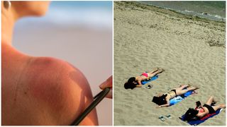 Cu ce e bine să te dai pe piele dacă te-a ars soarele. Trucuri rapide pentru calmarea pielii iritate