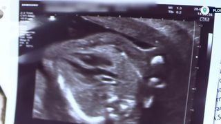 Acuzații de malpraxis după un avort spontan