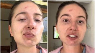 "Uită-te la fața mea. Mă umplu". Ireal ce a pățit o româncă ajunsă în Indonezia. Riscul la care te expui dacă mergi în vacanță în Bali