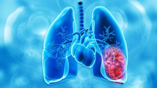 "În fiecare oră, un român moare". Dura realitate descrisă de un medic pneumolog. Care este principala cauză a cancerului bronho-pulmonar