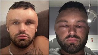 A încercat să-și vopsească firele albe de păr, dar i s-a umflat capul și acum ia 25 de medicamente pe zi