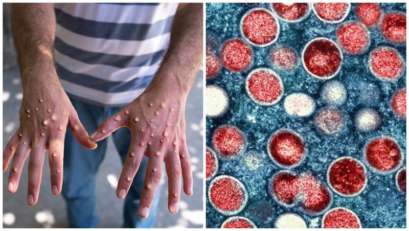 mpox, variola maimutei, thailanda, epidemie 