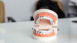 Cum să ai grijă de dinții tăi atunci c&acirc;nd porți aparat dentar&nbsp;