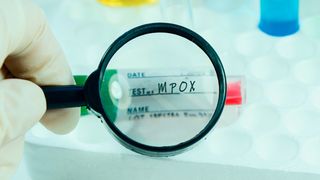 A fost descoperit leacul pentru mpox, "Variola Maimuței". Vaccinul a fost aprobat de OMS