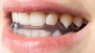 Bruxismul: cauze, simptome și soluții stomatologice eficiente