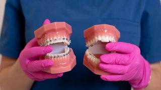 Tipuri de aparat dentar invizibil și particularitățile fiecăruia 