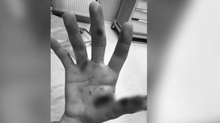 VIDEO &Icirc;și pun viața &icirc;n pericol din cauza unor provocări de pe social media. Mai multi copii au ajuns mutilați pe viață după provocarea petardelor