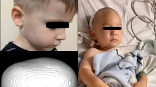 David și Denis s-au născut cu o malformație la nivelul cutiei craniene. Cei doi frați au nevoie de ajutorul nostru