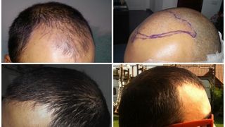 Transplant de păr Q-FUE - tehnică modernă &icirc;n acest domeniu&nbsp;