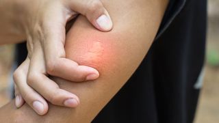 Ce &icirc;nvățăm din cazul de la Botoșani: Ghid rapid dacă te &icirc;nțeapă o albină. Medicul Tudor Ciuhodaru avertizeaz: "Fiecare minut contează &icirc;n reacțiile severe"