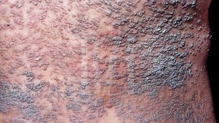 Un bărbat din Iași suferă de 24 de ani de boala Darier, o afecțiune rară și dureroasă