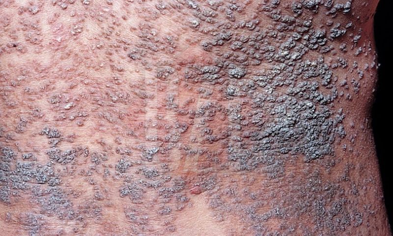 Un bărbat din Iași suferă de 24 de ani de boala Darier, o afecțiune rară și dureroasă