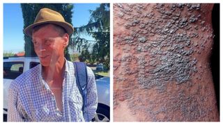 &bdquo;Mă scarpin p&acirc;nă &icirc;mi dă s&acirc;ngele&rdquo; Un bărbat din Iași suferă de 24 de ani de o boală rară și dureroasă