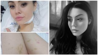 Boala rară de care suferă o tânără care nu se poate trata în România. Ministerul Sănătății nu recunoaște maladia: "Nu mai am resurse. Am făcut tot ce a ținut de mine. Acum vă cer ajutorul"