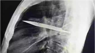 A trăit timp de 8 ani cu un cuțit înfipt în piept. Medicii au rămas șocați când au văzut pacientul