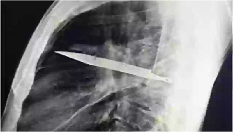 A trăit timp de 8 ani cu un cuțit înfipt în piept