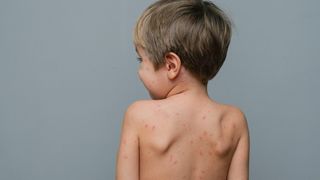 VIDEO Rom&acirc;nia, &icirc;n fața unei crize de sănătate publică: Rujeola și alte boli ereditare revin din cauza scăderii vaccinării