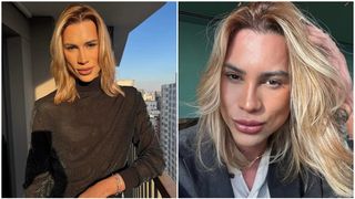 Operația estetică pentru "ochi de vulpe” i-a adus moartea unui influencer brazilian de 31 de ani