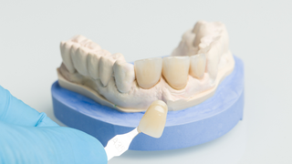 (P) Fațetele dentare &ndash; soluția modernă pentru un z&acirc;mbet natural și &icirc;ncrezător