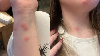 O t&acirc;nără a ajuns la spital după o călătorie cu trenul CFR. Ea a fost mușcată de ploșnițe